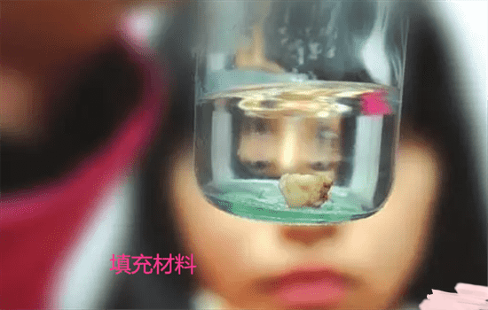 垫下巴歪了下嘴唇也歪,垫下巴失败案例,垫下巴