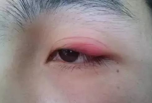 1,眼线笔易引发过敏,眼皮红肿不做美瞳线,用眼线笔不就好了?