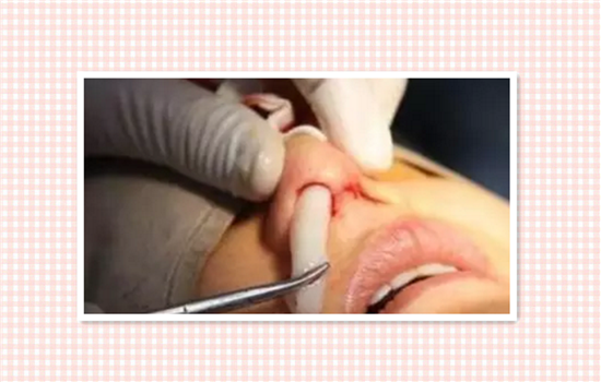 硅胶隆鼻多久完全恢复 鼻子两周自然完全康复