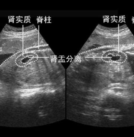 胎儿肾盂分离生下后果 胎儿肾盂分离怎么办