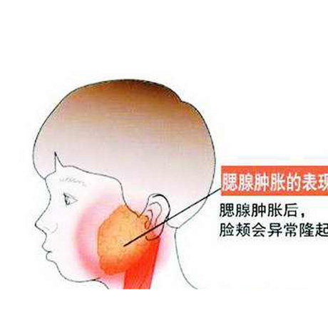 腮腺炎脸肿几天能消肿 腮腺炎脸一定会肿吗