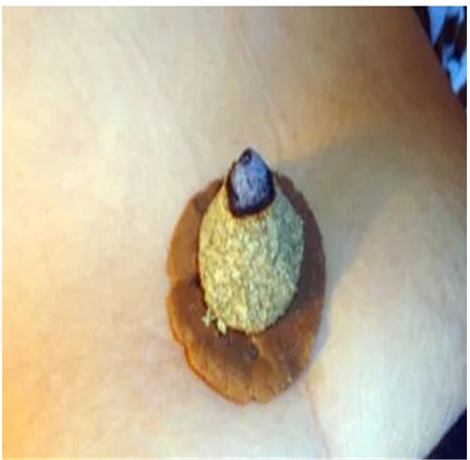艾灸手法教程 艾灸手法汇总介绍