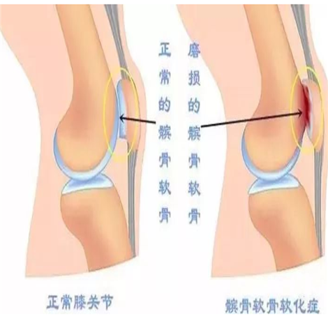 膝关节炎的锻炼方法 患上膝关节炎怎么护理好