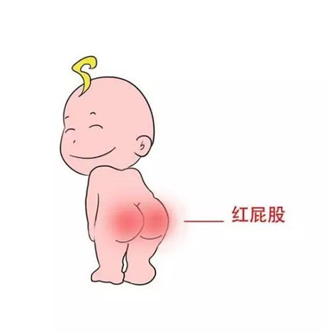 夏天婴儿红屁股怎么办 快来试试这六招
