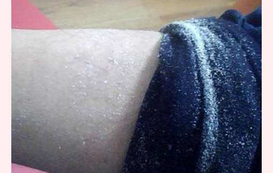 冬天秋裤上面满是白色的皮屑冬天怎么去除衣服上的皮屑