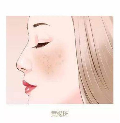 容易长斑的女性有什么特点 怎么预防长斑