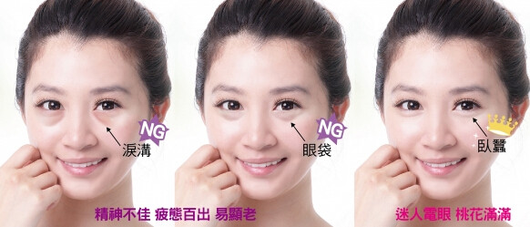 泪沟和眼袋的区别图片 泪沟是怎么形成的