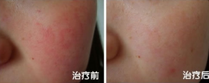 红血丝怎么消除 简单几招告诉你