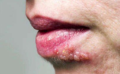 嘴唇老是干燥想舔是上火了吗 嘴唇上火起泡怎么办